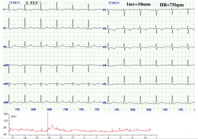 八大病例：教你看懂心肌缺血发作时的心电图表现