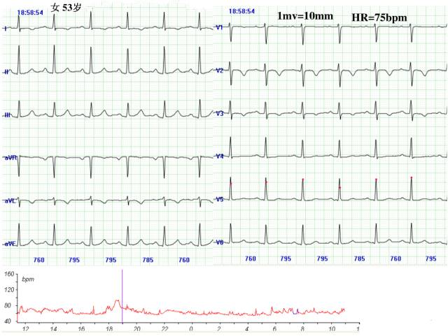八大病例：教你看懂心肌缺血发作时的心电图表现