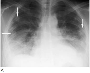 4种肺部细菌感染的影像学鉴别（多图）