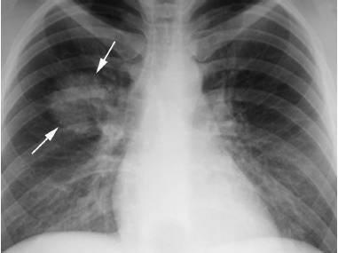 4种肺部细菌感染的影像学鉴别（多图）
