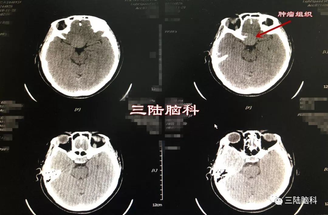 【三陆病例】46岁女性右眼失明3月，竟是因为鞍区脑膜瘤