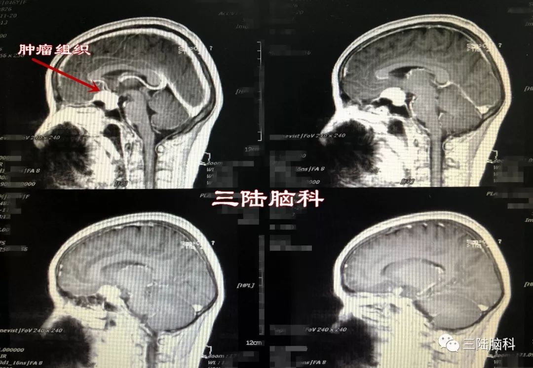 【三陆病例】46岁女性右眼失明3月，竟是因为鞍区脑膜瘤