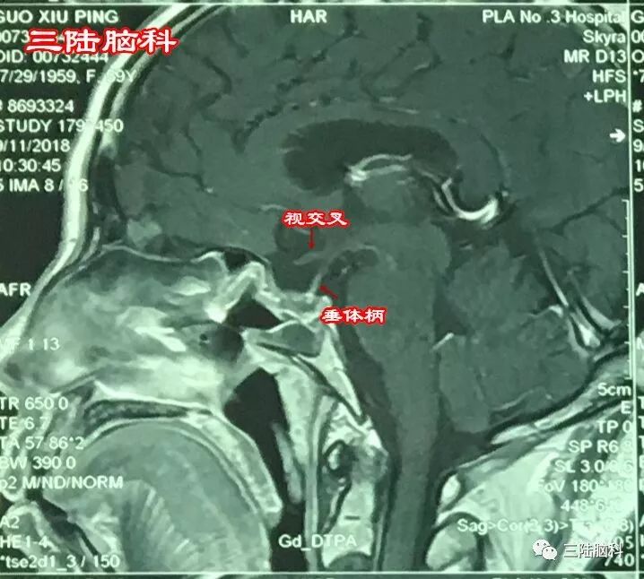 【三陆病例】“视物模糊、头痛”别以为是小事，也有可能是“垂体瘤”