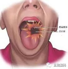 【三陆脑科】脑外科医生告诉你什么是舌咽神经痛？