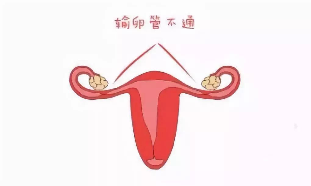 大多数女性都不知道，有40-50%的不孕不育，是输卵管病变引起的