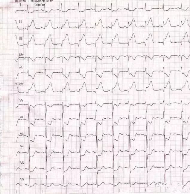 除了心肌梗死心电图，你还能get到其他致命心电图吗？