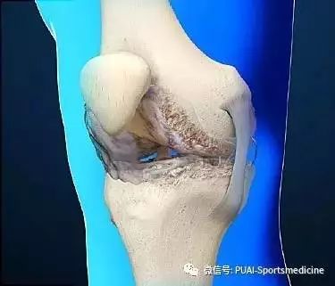 骨科医生关于“膝关节骨性关节炎”的几点建议，值得一看