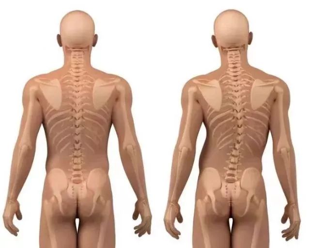 「脊柱侧弯」有多恐怖你知道吗？严重者可影响心肺功能和肠胃系统！