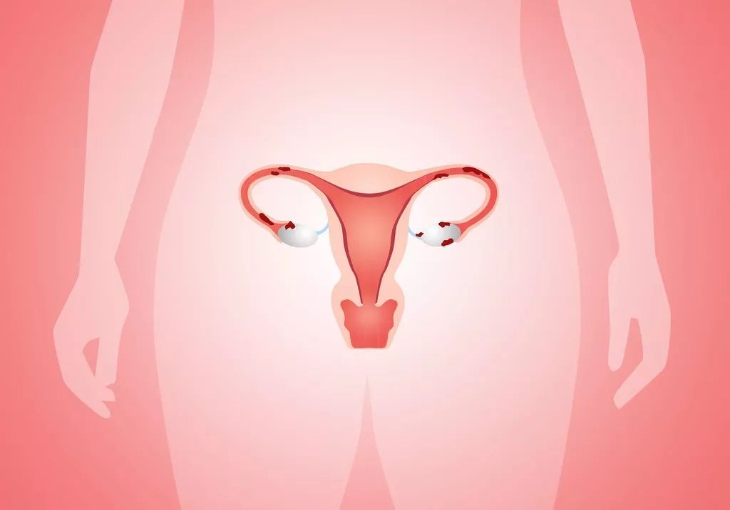 输卵管不通怎么办 三大方法治疗输卵管不通