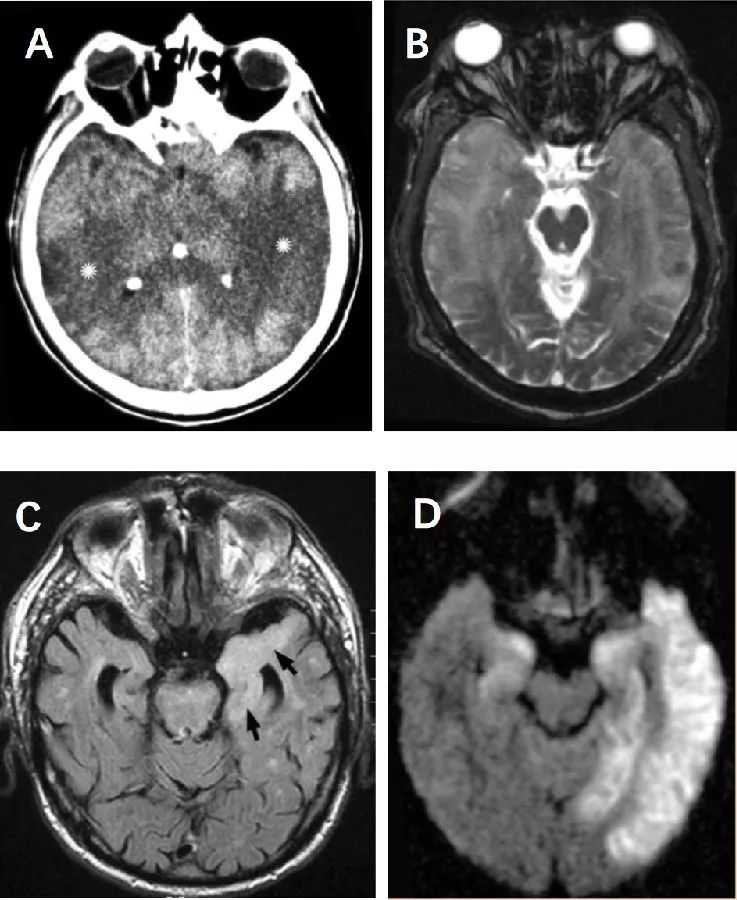 CNS感染的MRI表现第一弹——病毒感染