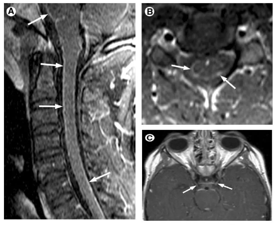 CNS感染的MRI表现第三弹——螺旋体、寄生虫感染