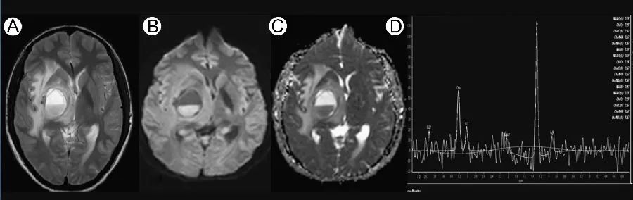 CNS感染的MRI表现第三弹——螺旋体、寄生虫感染