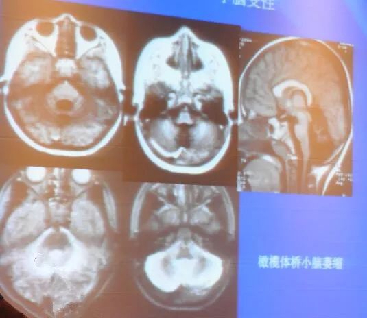 [21NCN]彭英：慢性酒精中毒性脑病诊治中国专家共识解读