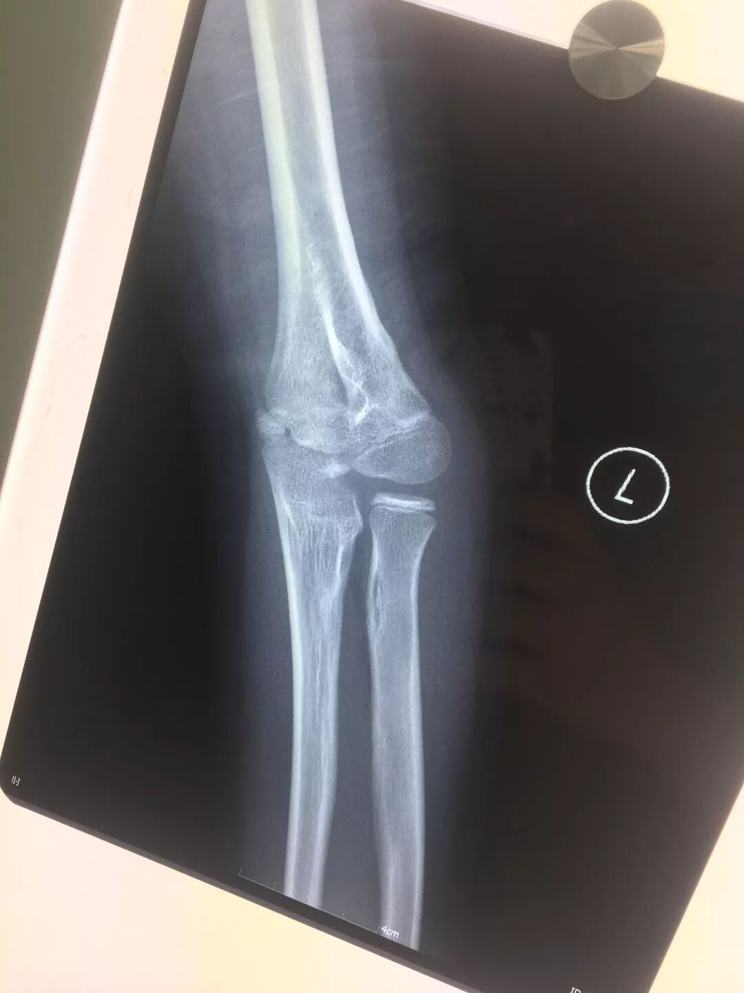 胳膊肘往里拐孩子这种情形不容轻忽