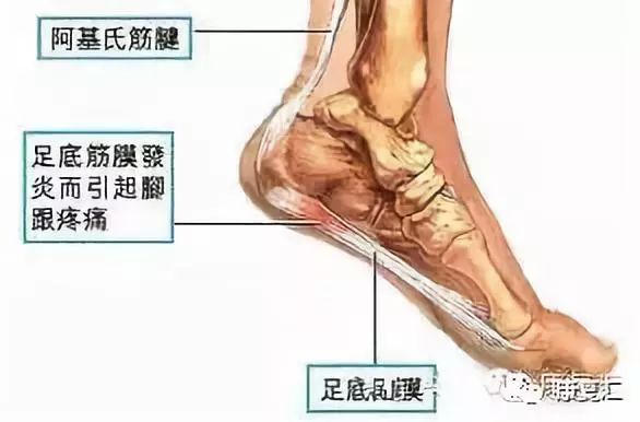 脚底板经常疼，你可能有足底筋膜炎（附康复图解）