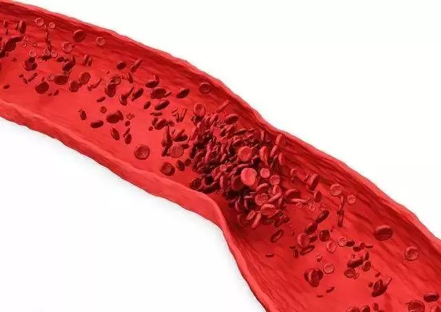 血栓到底是怎么形成的？