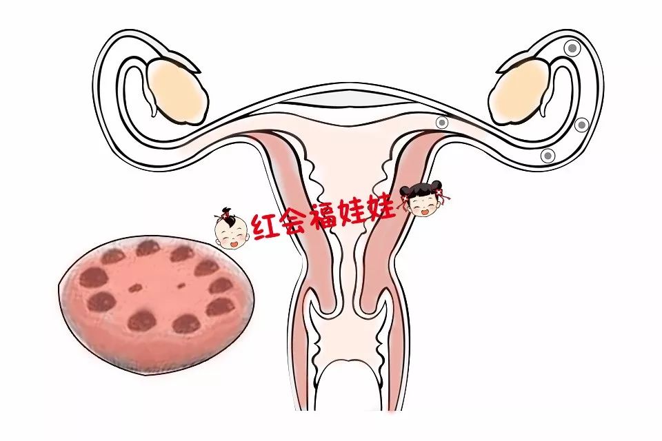 多囊卵巢综合征患者备孕，需要从哪些方便调理？