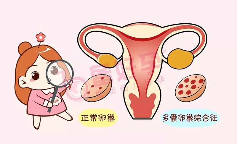 多囊卵巢综合征可以做试管婴儿吗?