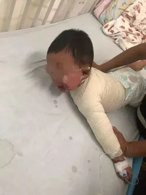 男婴被100℃水烫伤！妈妈不顾全家反对做了一件事，医生也点赞！