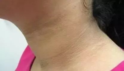 脖子上出现这个东西，是糖尿病的表现!赶快重视起来!