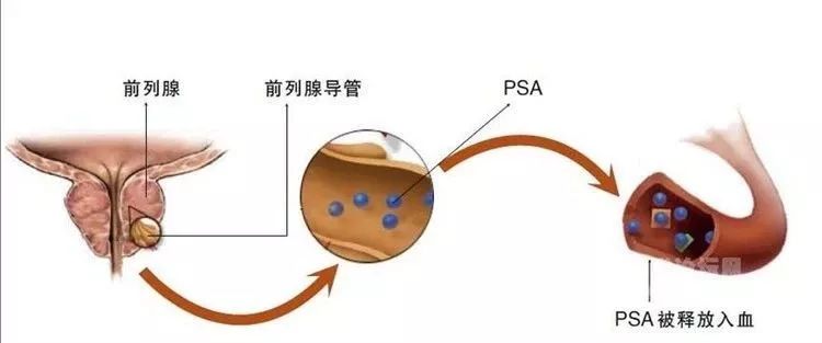 PSA异常就是前列腺癌？该如何看待PSA值与癌的关系？