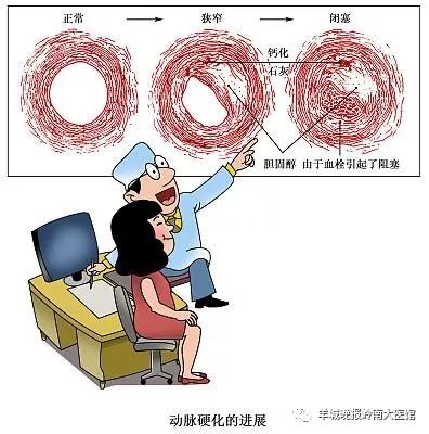 注意！10个中国成年人3个颈动脉硬化，没症状≠没危险