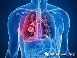 【上海名医】我国每年约有40万人被确诊为肺癌 警惕早期症状