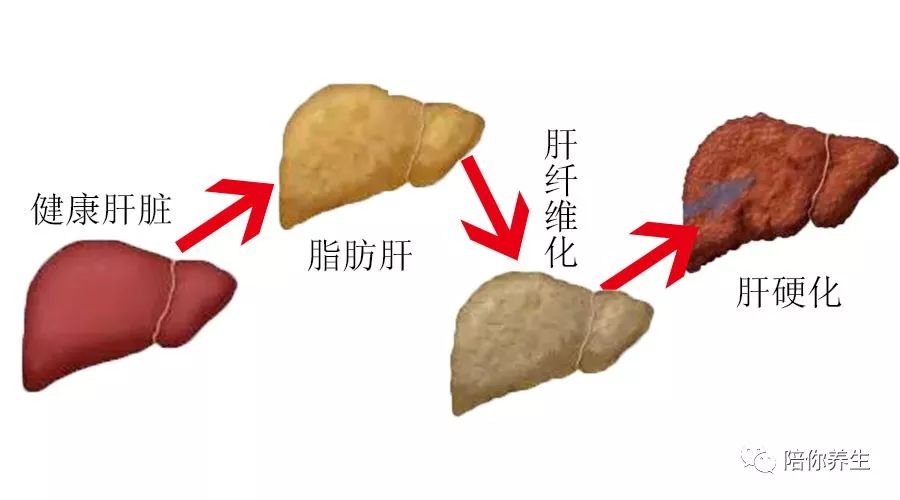 你的肝脏该减肥了 从脂肪肝到肝癌只有仅仅四步