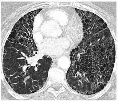寻常型间质性肺炎（UIP）的临床、组织学及CT特点
