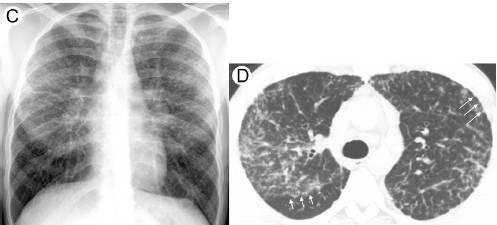 结节病的肺部特点和影像学特点，此一篇文章足矣