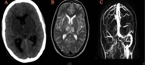 双侧丘脑异常信号的病毒性脑炎，是特异性还是巧合？