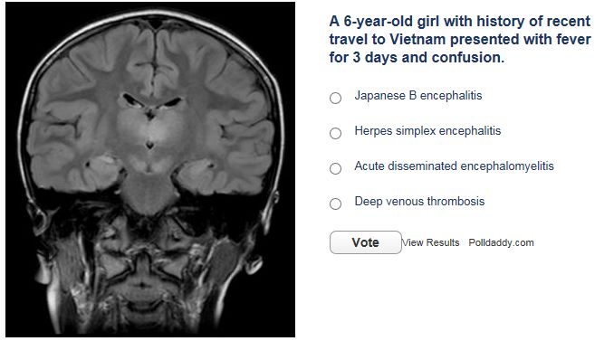 双侧丘脑异常信号的病毒性脑炎，是特异性还是巧合？