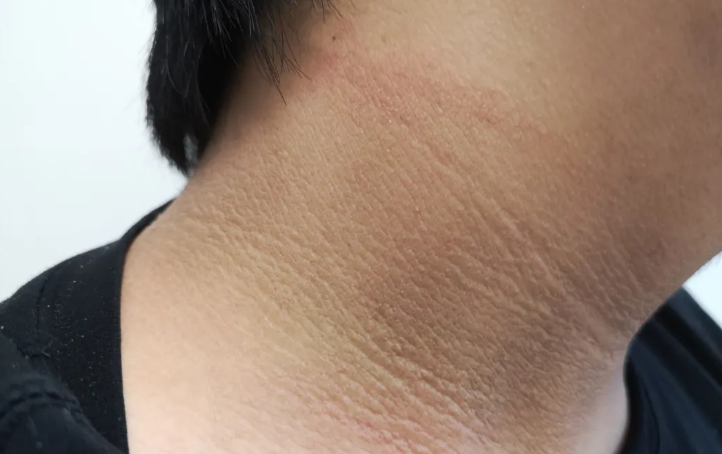 脖子上出现这个东西，是糖尿病的表现!赶快重视起来!