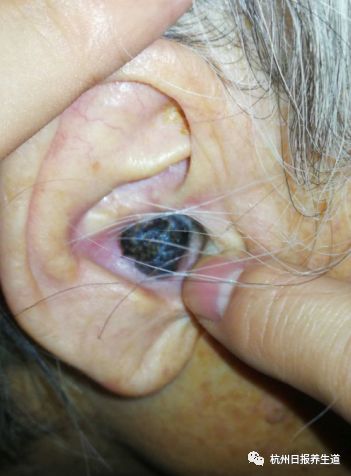 可怕！80岁老奶奶耳朵里长出了一个“黑蚕豆”，一查竟是癌！这些可致耳道感染甚至恶变的小动作，你平时也经常在做！